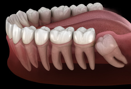 3D render of an impacted tooth