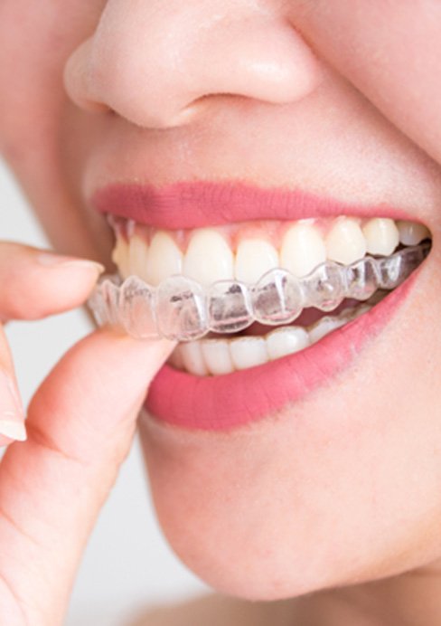 Closeup of patient putting on clear aligner